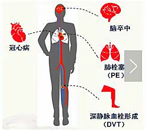 预防深静脉血栓知识宣教