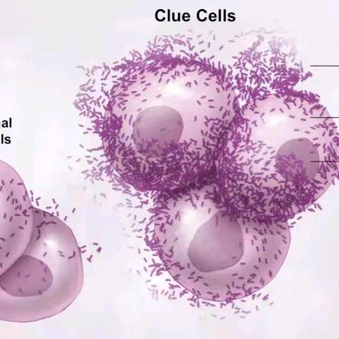 什么是“线索细胞”？有何临床意义？