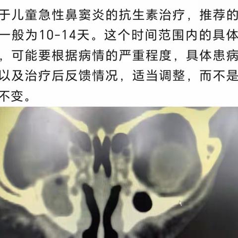 儿童鼻窦炎治疗疑惑解答