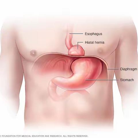 熟悉的陌生病——食管裂孔疝：腹腔镜食管裂孔疝修补术+胃底折叠术