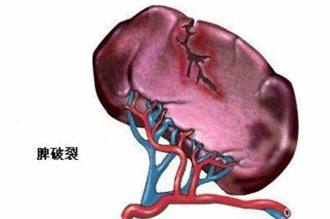 甘肃省人民医院普外科（新区分院）成功保守治疗一例脾破裂患者