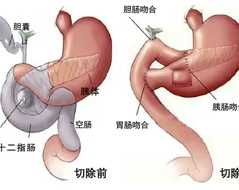 【重大突破！】甘肃省人民医院新区分院普外科成功完成首例腹腔镜辅助胰十二指肠切除术