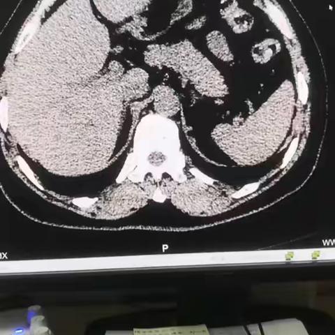 酒泉同康（原同济）医院外科团队今日完成一例经腹腔镜左侧肾、输尿管全切术