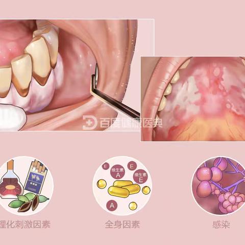 口腔黏膜白斑是什么？