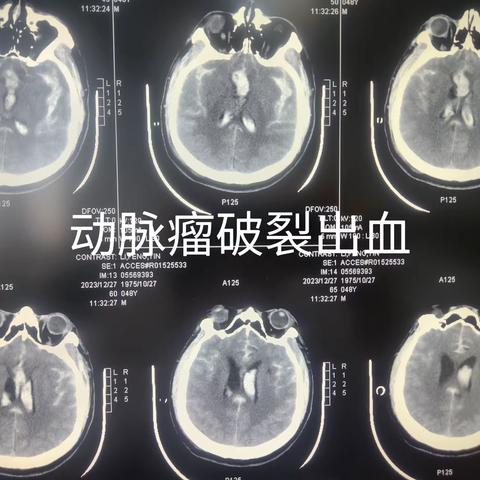 我院神经外科团队成功完成一例颅内动脉瘤血管内介入栓塞术