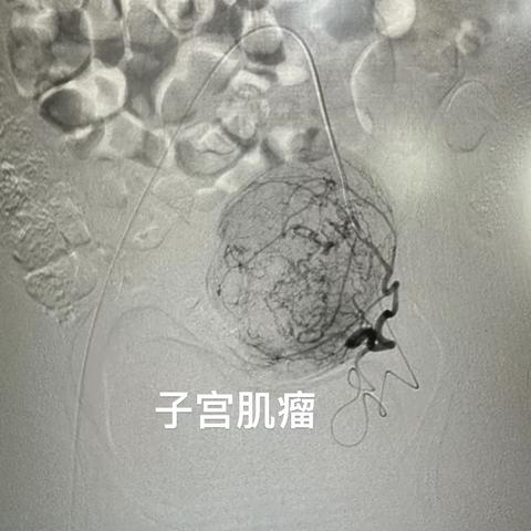 子宫肌瘤遇见介入，保住子宫，治愈肌瘤，做完美女人