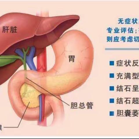 胆囊结石小知识