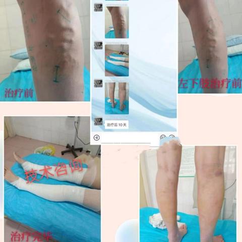 12 月11 日（临床实操学习）“弯针微创闭合加注射一次治静脉曲张、老烂腿、中医治肛肠、颅骨骨膜外触极、舌下排瘀治脑血管病偏瘫五合一 ‍ ‍ ‍