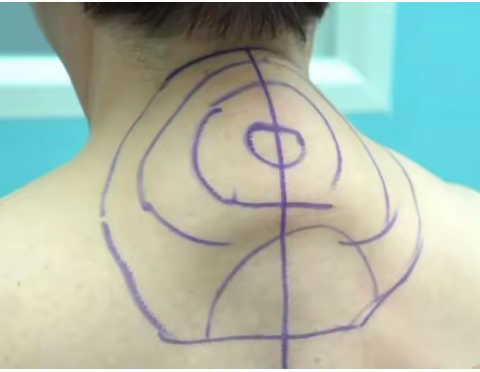 6月7日报到，8日临床学习，30分钟治疗富贵包—针眼微创无留疤