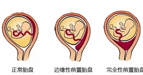 惊心动魄第三胎——凶险性前置胎盘，人医妙手，母子平安