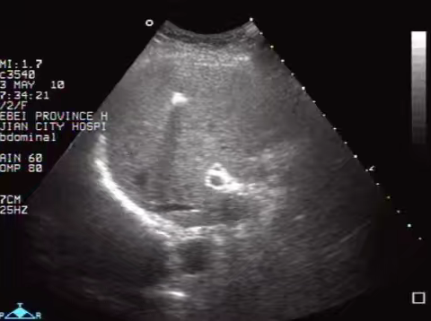 肝内强回声斑的超声鉴别