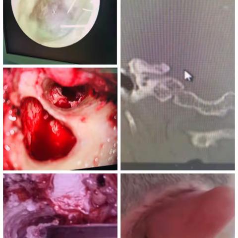通辽市第二人民医院耳鼻喉科——完成两例鼻内镜手术