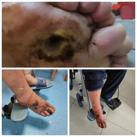 血小板源生长因子凝胶—面临截肢到健步如飞