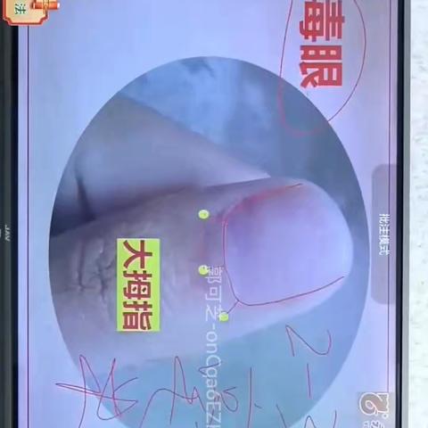 道医“毒眼”治疗“带状疱疹”