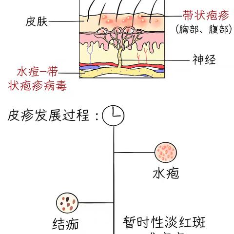 带状疱疹：你需要了解的健康知识