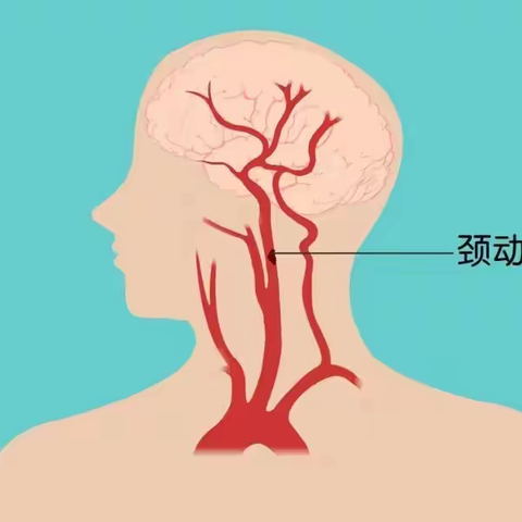 健康科普——你了解颈动脉斑块吗？