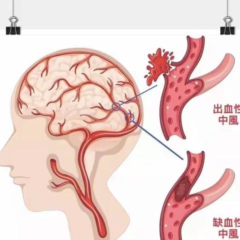 脑卒中后的康复训练助你重获新生