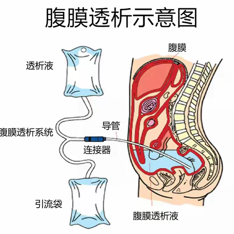 【一医.医者红】腹膜透析：守护生命，让透析更轻松