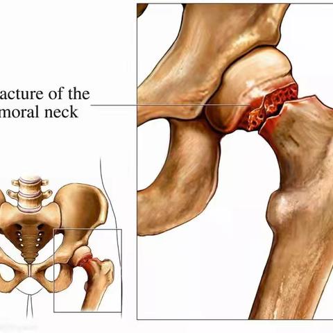 老年人常见骨折之股骨颈骨折