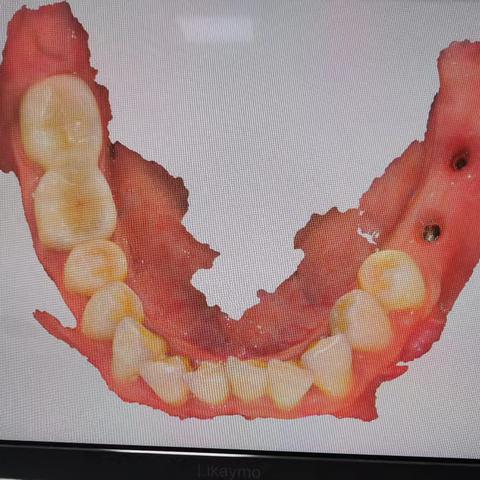 邢台市襄都区医院引进口腔数字化扫描仪，牙齿取模“黑科技”，让您看牙更舒适