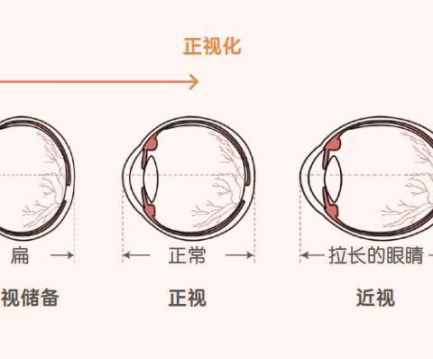 你真的了解近视吗？