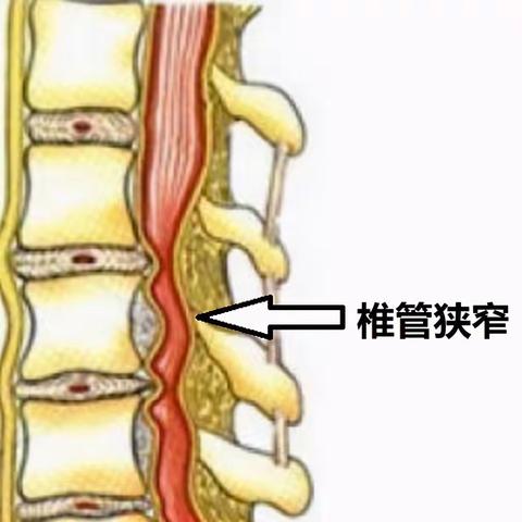 脑外三开展特殊颈椎管狭窄手术一例