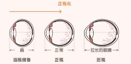 近视防控科普之---“远视储备”