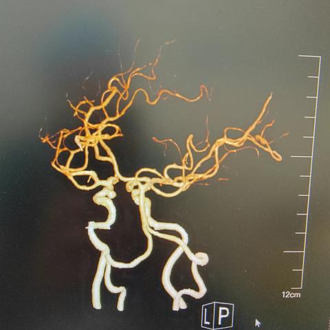 介入科综合介入组37床左颈内动脉眼段动脉瘤密网支架治疗