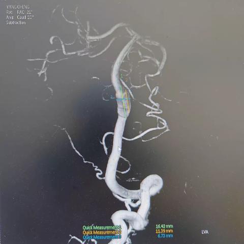 介入科综合介入组26床左侧椎动脉梭型动脉瘤密网支架治疗