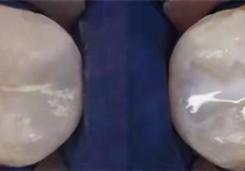 牙齿的保护衣——窝沟封闭