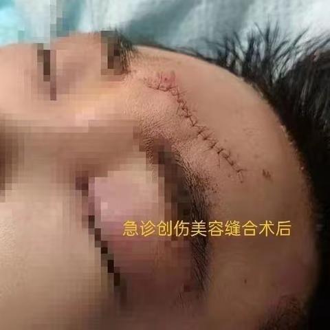 创伤美容缝合之是“缝合”还是“粘