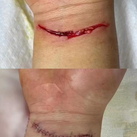 美容缝合知多少