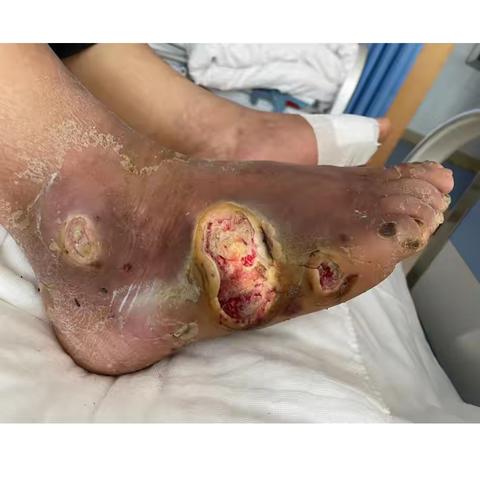 别让糖尿病足悄悄偷走你的健康