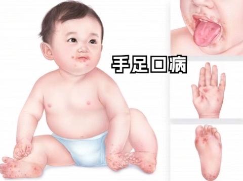 预防手足口，健康我先行——汾西县县直机关幼儿园保健知识宣传