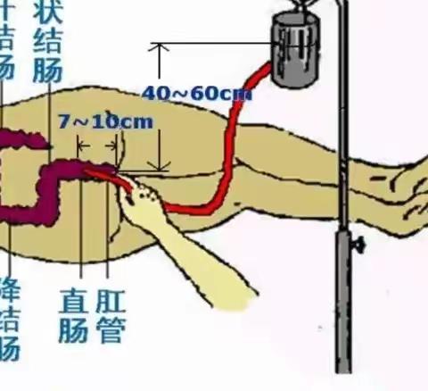 传承中医文化、守护女性健康  ——泾阳县桥底中心卫生院开展中药直肠滴入疗法