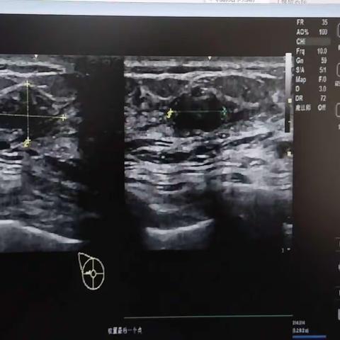 潼关县妇幼保健院顺利完成首例男性乳腺肿物切除手术