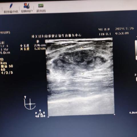 孕前乳腺基线检查   健康你我他