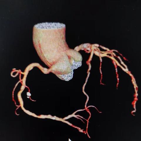 冠状动脉CTA