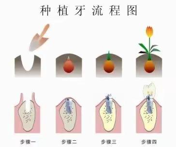 维密种植牙齿的全面介绍，赶紧收藏！