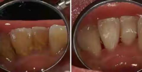 美牙还分等级，涨知识了！