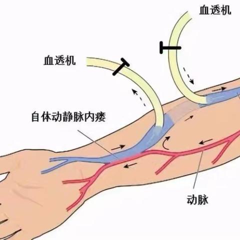 动静脉内瘘围手术期护理