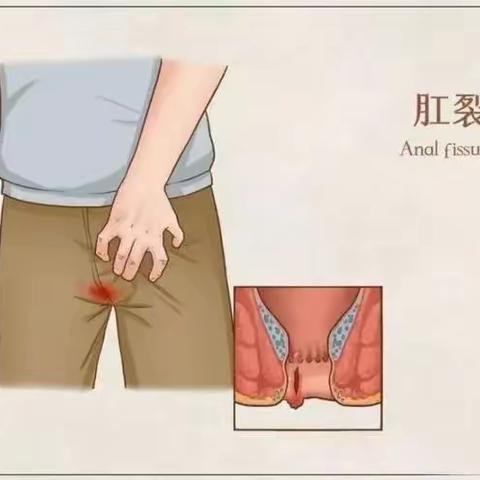 “肛裂”——难言的痛