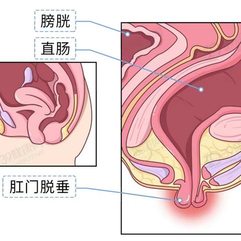 直肠脱垂 & 早知道