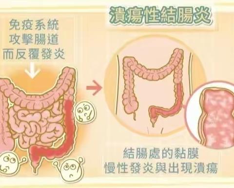 溃疡性结肠炎复发因素