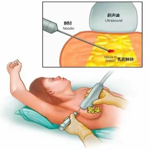 “针尖上的艺术”之超声引导下乳腺穿刺活检