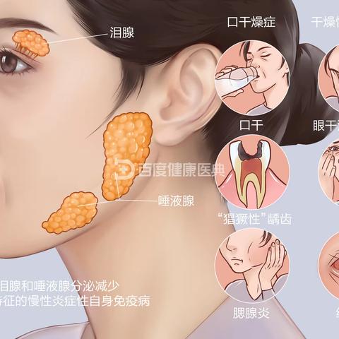 什么是干燥综合征