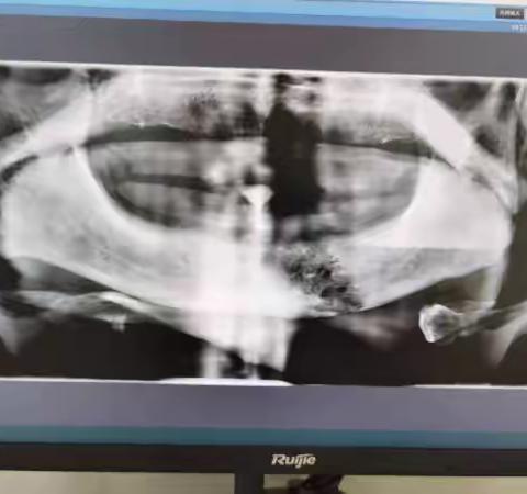 小残根，大隐患，及时治疗，身体棒！