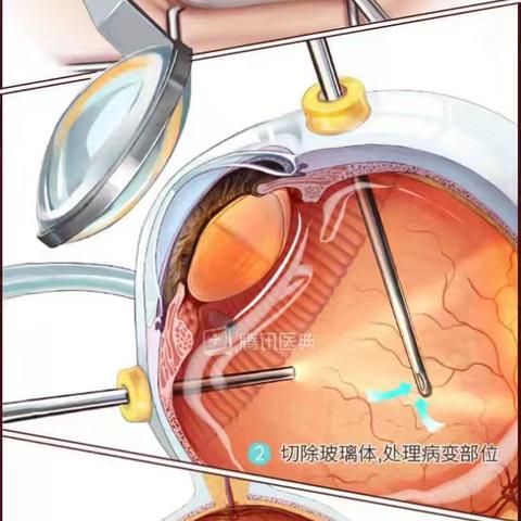 【新突破】擦亮心灵之窗——眼科成功实施三例玻璃体切割四级手术，还眼疾患者光明