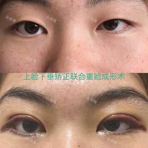 通辽市第二人民医院眼科 ﻿眼整形门诊：专业守护眼部美丽与健康