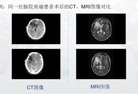 【新技术】CT与MRI图像融合放疗技术